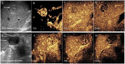 Contrast-enhanced ultrasound and microwave ablation of Epstein–Barr virus associated smooth muscle tumors in a patient with AIDS: a case report